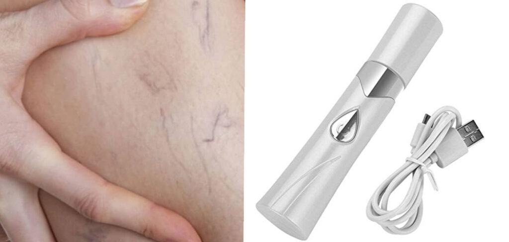 How to Use Blue Light Pen for Spider Veins