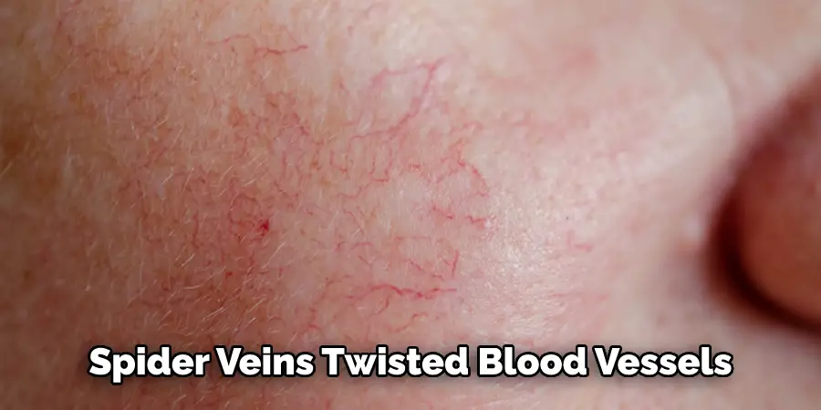 Spider Veins Twisted Blood Vessels